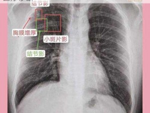 采用先进技术，实现 100%胸片曝光，助力医疗诊断